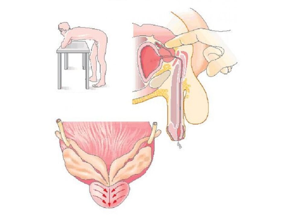 Technique of prostate massage by a doctor to take an analysis of the secretion